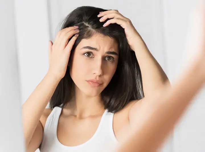 9 Best Home Remedies for Dandruff